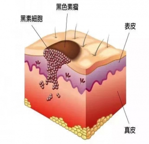 惡性黑色素瘤