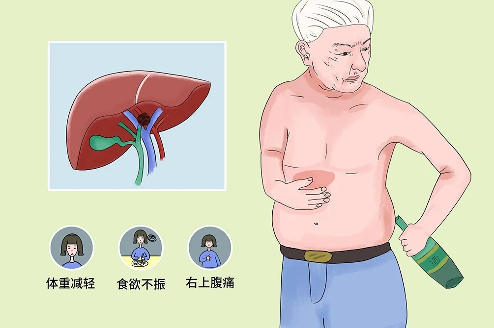 抗癌必修課——肝癌