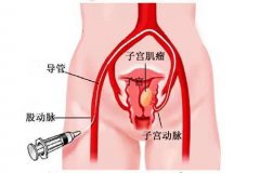 子宮栓塞介入手術(shù)過(guò)程